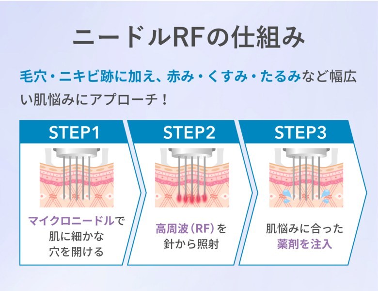 ニードルRFの仕組み STEP1 マイクロニードルで肌に細かな穴を開ける／STEP2 高周波（RF）を針から照射／STEP3 肌悩みに合った薬剤を注入