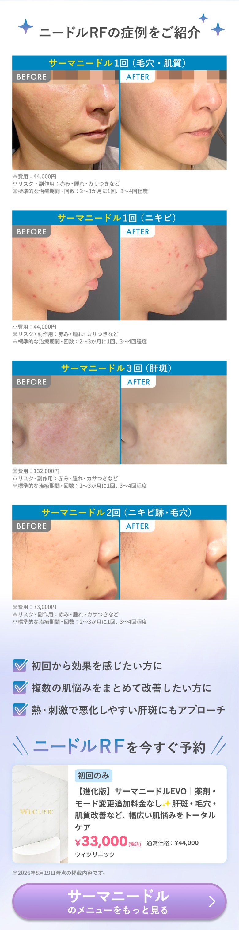 ニードルRFの症例をご紹介